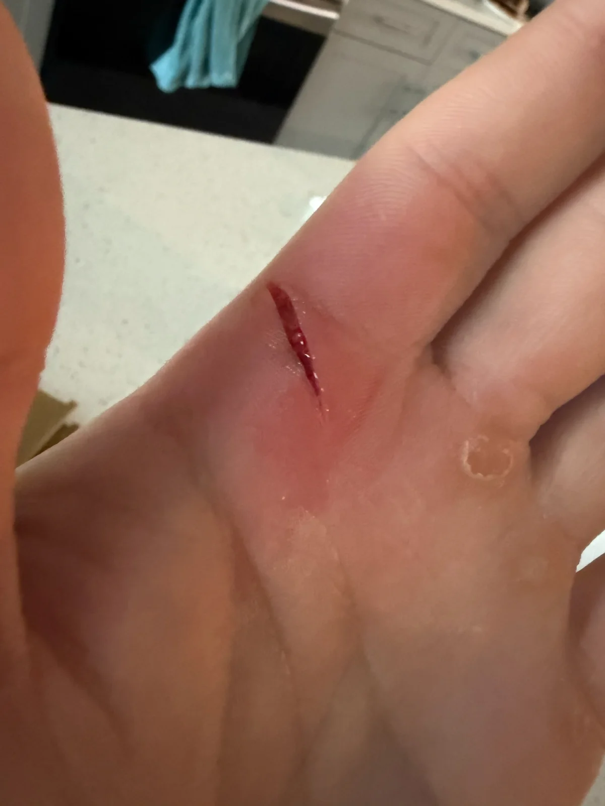 Photo of a clean, approximately 1.5 cm linear laceration on the palm-side of an index finger near the proximal phalanx, with edges close together and active capillary bleeding.